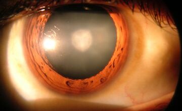 هوش مصنوعی به کمک درمان آب‌مروارید آمد