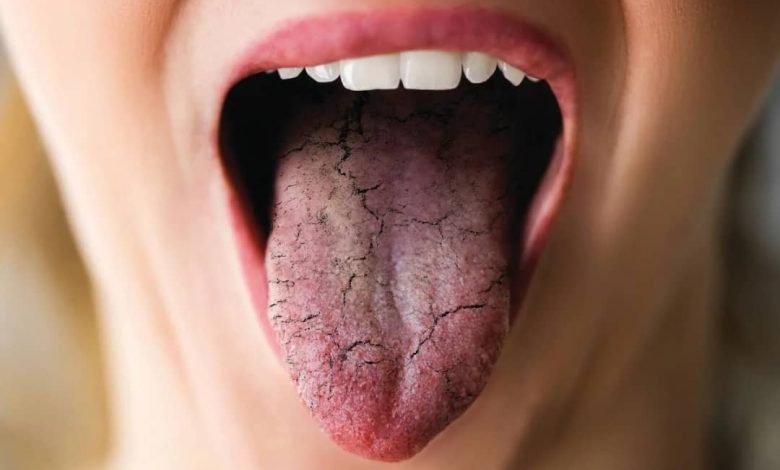 پژوهشگران چینی مکانیسم خشکی دهان را کشف کردند