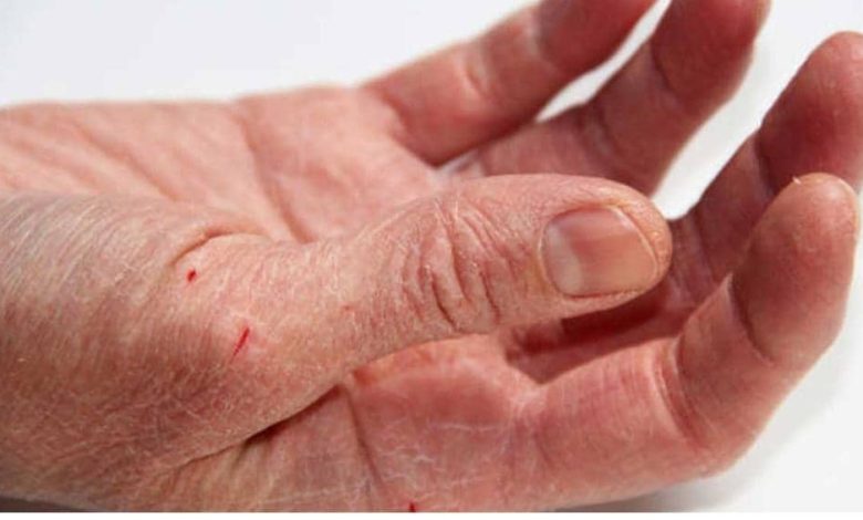 روش های درمان خشکی پوست دست در خانه