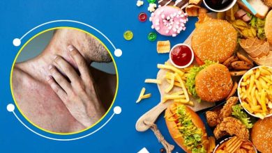 باید ها و نباید های تغذیه ای در هنگام ابتلا به آبله مرغان را جدی بگیرید