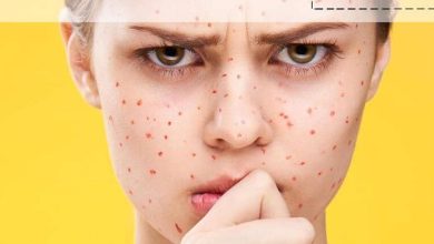 کمبود کدام ویتامین ‌ها باعث لک صورت می ‌شود