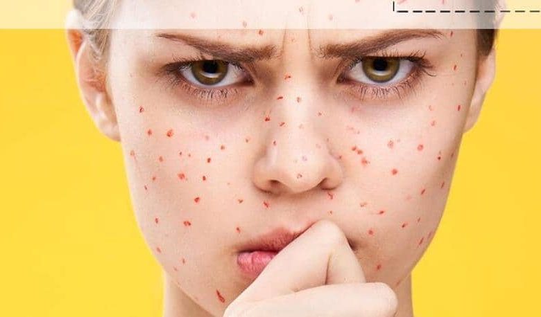 کمبود کدام ویتامین ‌ها باعث لک صورت می ‌شود