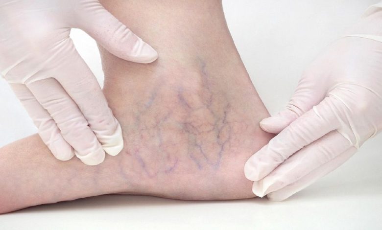 علائم اولیه واریس را بشناسید