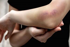 علت کبودی ناگهانی بی‌دلیل روی بدن چیست؟