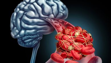 علائمی که می‌گویند سکته مغزی کرده‌اید